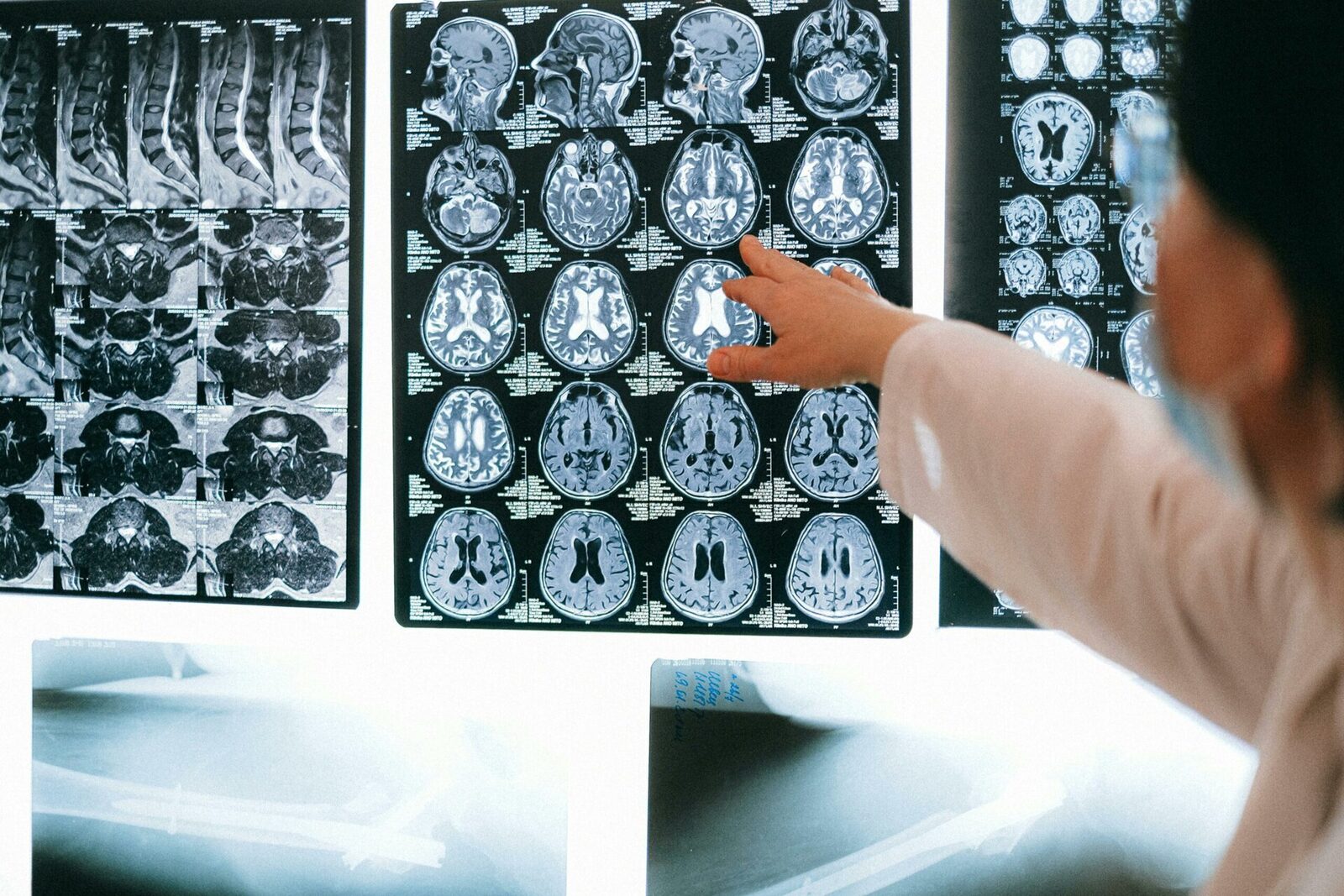 Impactul inteligenței artificiale asupra creșterii șanselor de recuperare completă după AVC