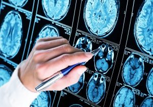 Un sistem AI identifică leziuni cerebrale nevăzute la copiii cu epilepsie