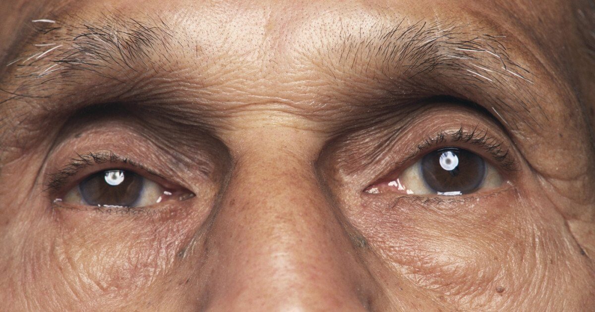 Bacterie oculară legată de Alzheimer: noi descoperiri alarmante