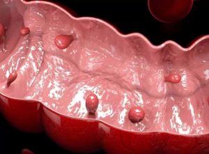 Polipii sesili din colon: Leziunile silențioase care cresc riscul de cancer. Detectare și pericol.