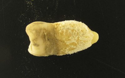 Bacteria scarlatinei, găsită într-o mumie din America de Sud: Revoluție în istorie?