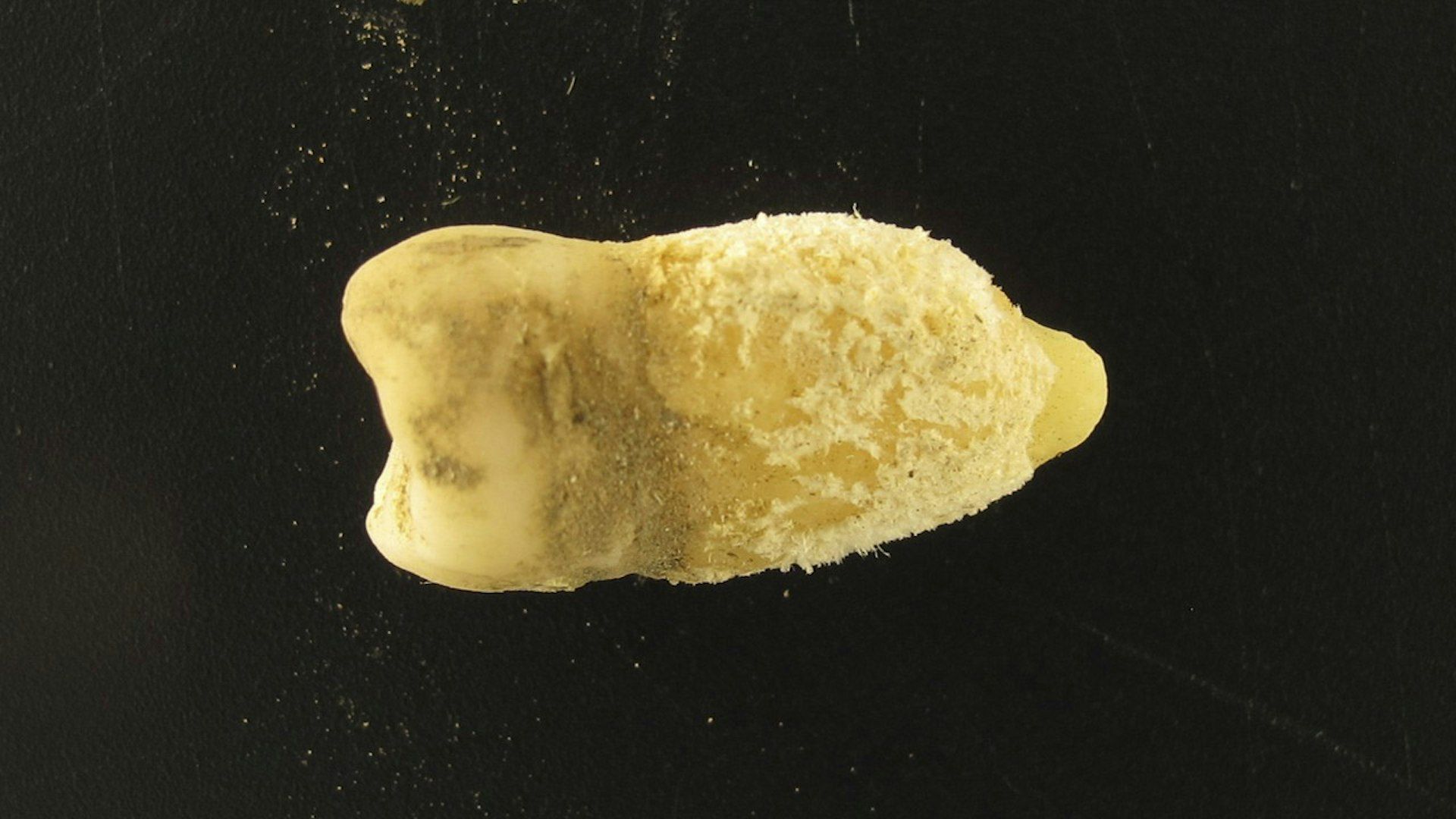 Bacteria scarlatinei, găsită într-o mumie din America de Sud: Revoluție în istorie?