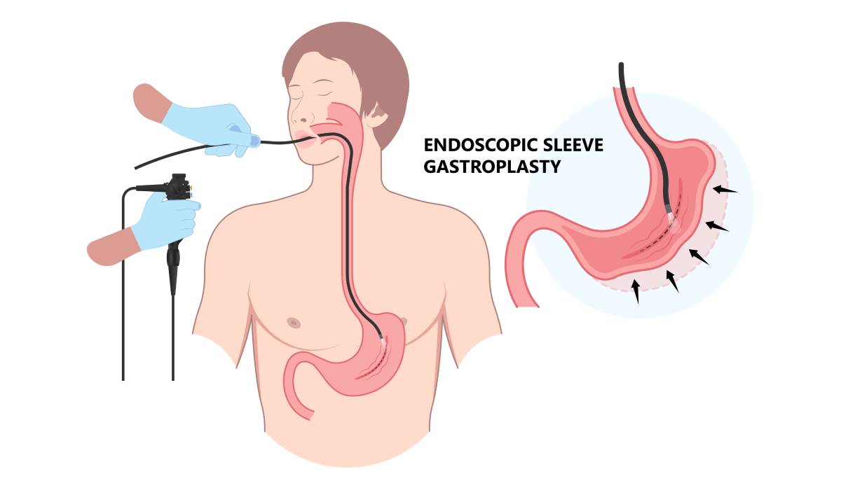 EȘECUL dietelor? Noua metodă de slăbire fără operație, promite minuni