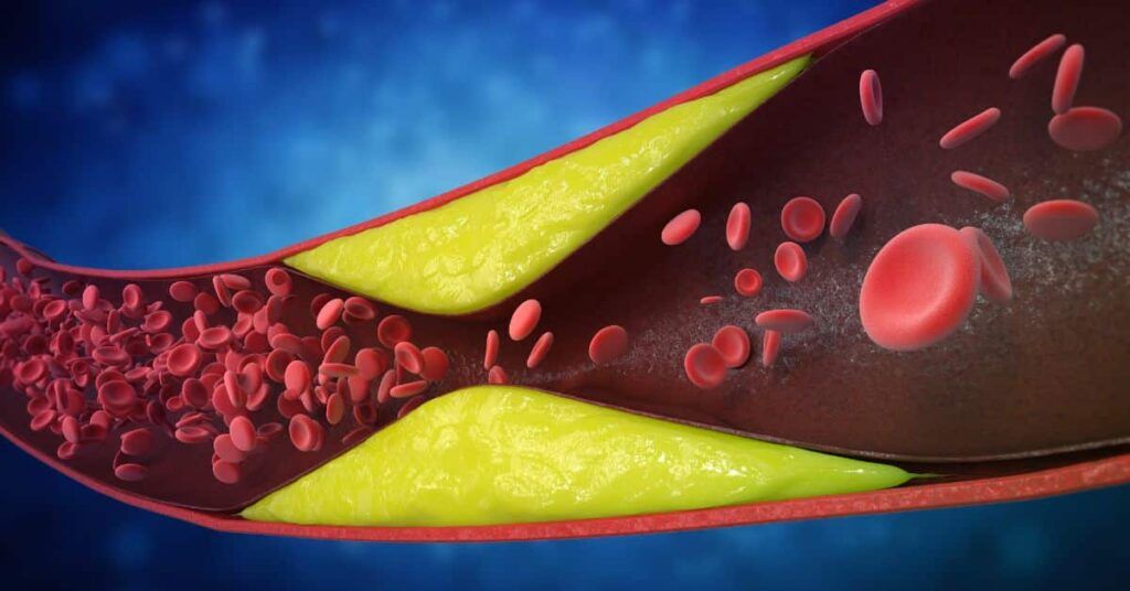 Avertisment de la medici: 7 semne că arterele sunt blocate. Le ignori?