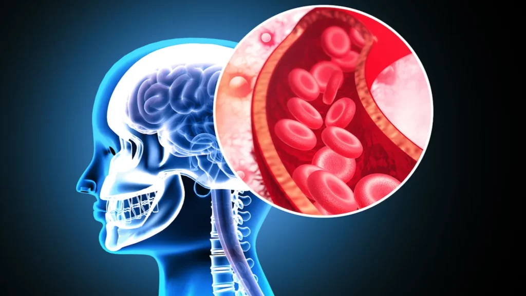 Grupa de sânge care crește RISCUL de AVC înainte de 60 de ani
