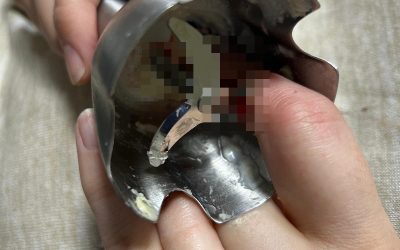 Două femei din Iași, victime ale unor accidente casnice grave și ajung la spital