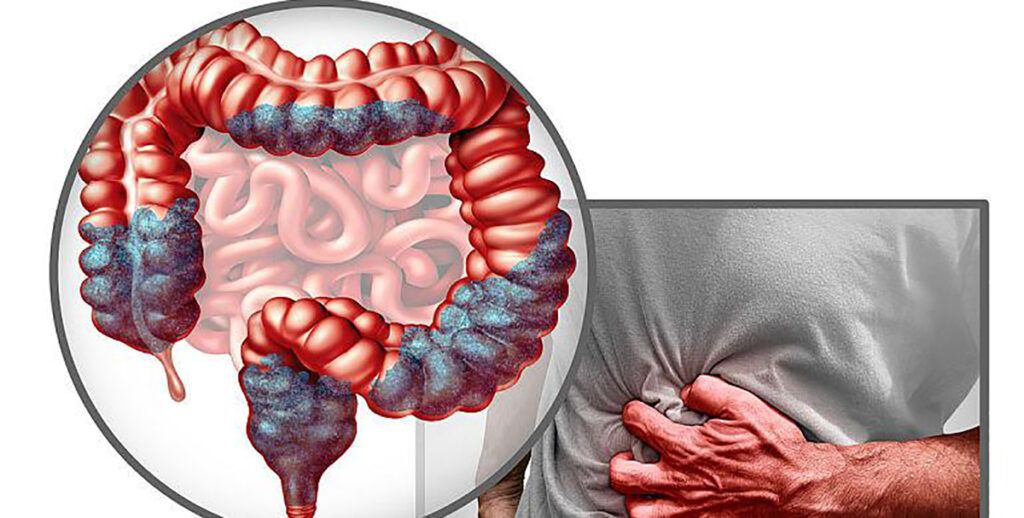 Mâncarea banală ce sporește riscul de cancer de colon: Află ce e!