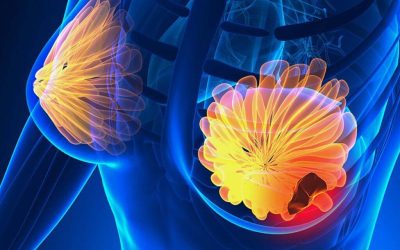 Semnele ascunse ale cancerului de sân: 5 simptome la care să fii atentă