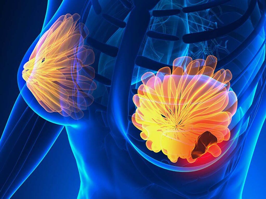 Semnele ascunse ale cancerului de sân: 5 simptome la care să fii atentă