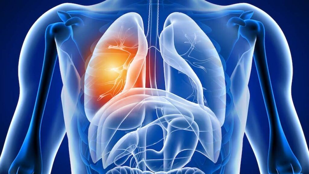 Răni ascunse: Ce suferă plămânii după COVID-19 în România