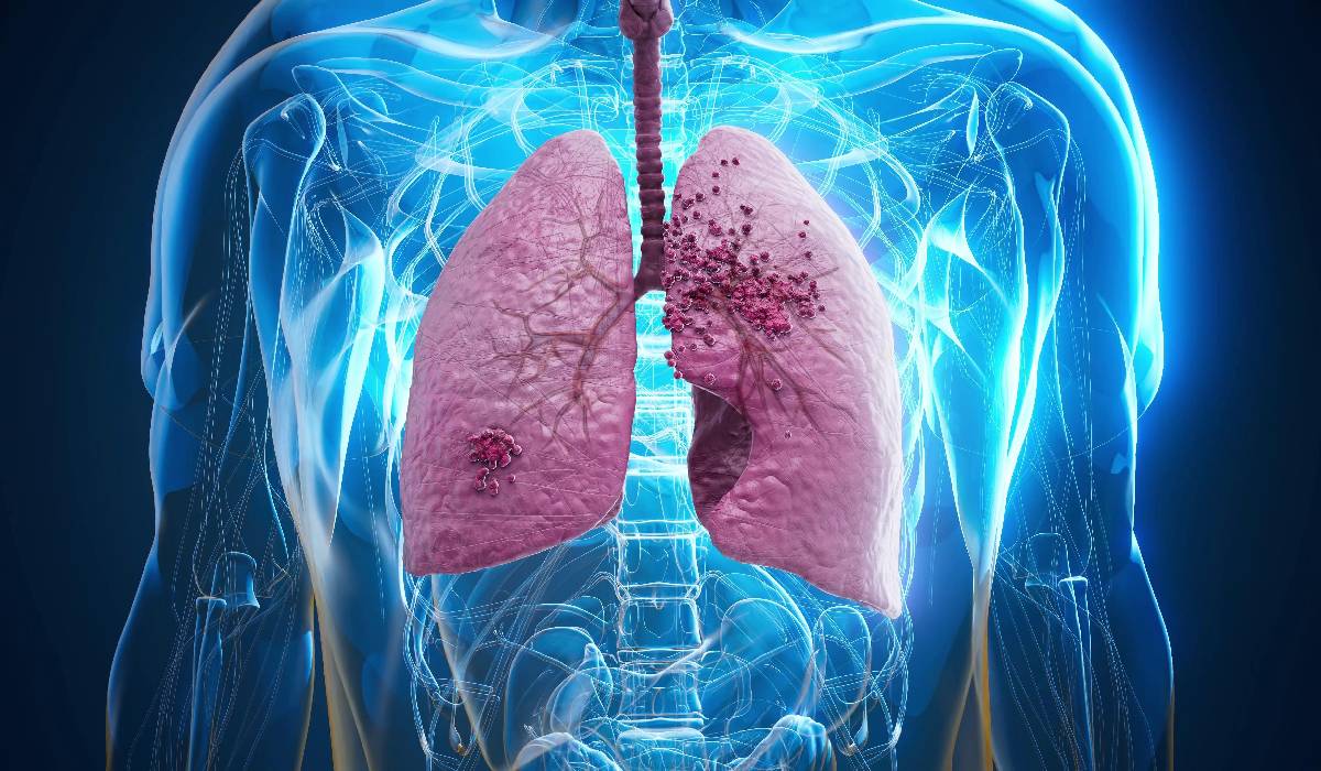 Cancerul pulmonar: Adevăruri și mituri care te pot salva
