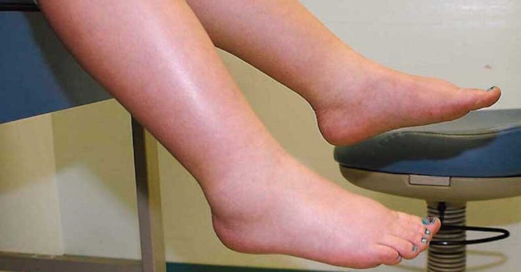 Leguma minune: Spune adio picioarelor umflate și circulației proaste