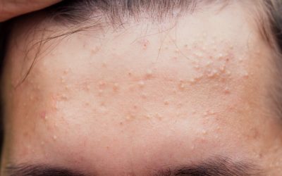 Acid salicilic: Protocol anti-acnee în 3 pași. Ghid complet (P)