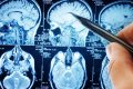 Creierul vorbitor fără cuvinte: Un ajutor major după AVC