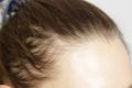 Injecții slăbit: Cabluți cu alopecia?