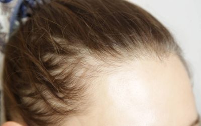 Injecții slăbit: Cabluți cu alopecia?