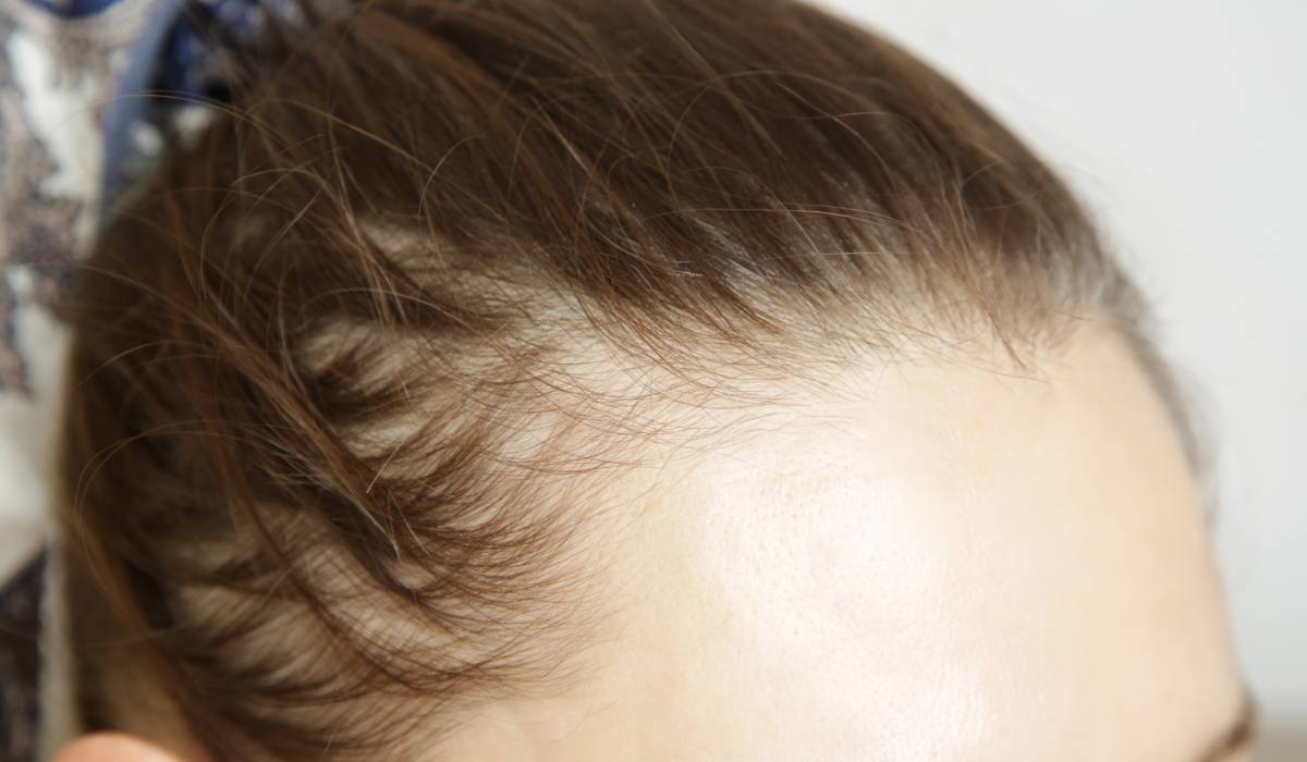 Injecții slăbit: Cabluți cu alopecia?