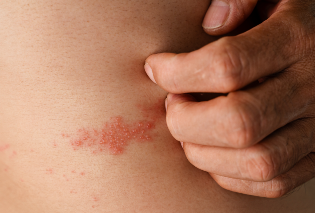 Mâncărime persistentă, semn de cancer rar: Ce ascunde eczema