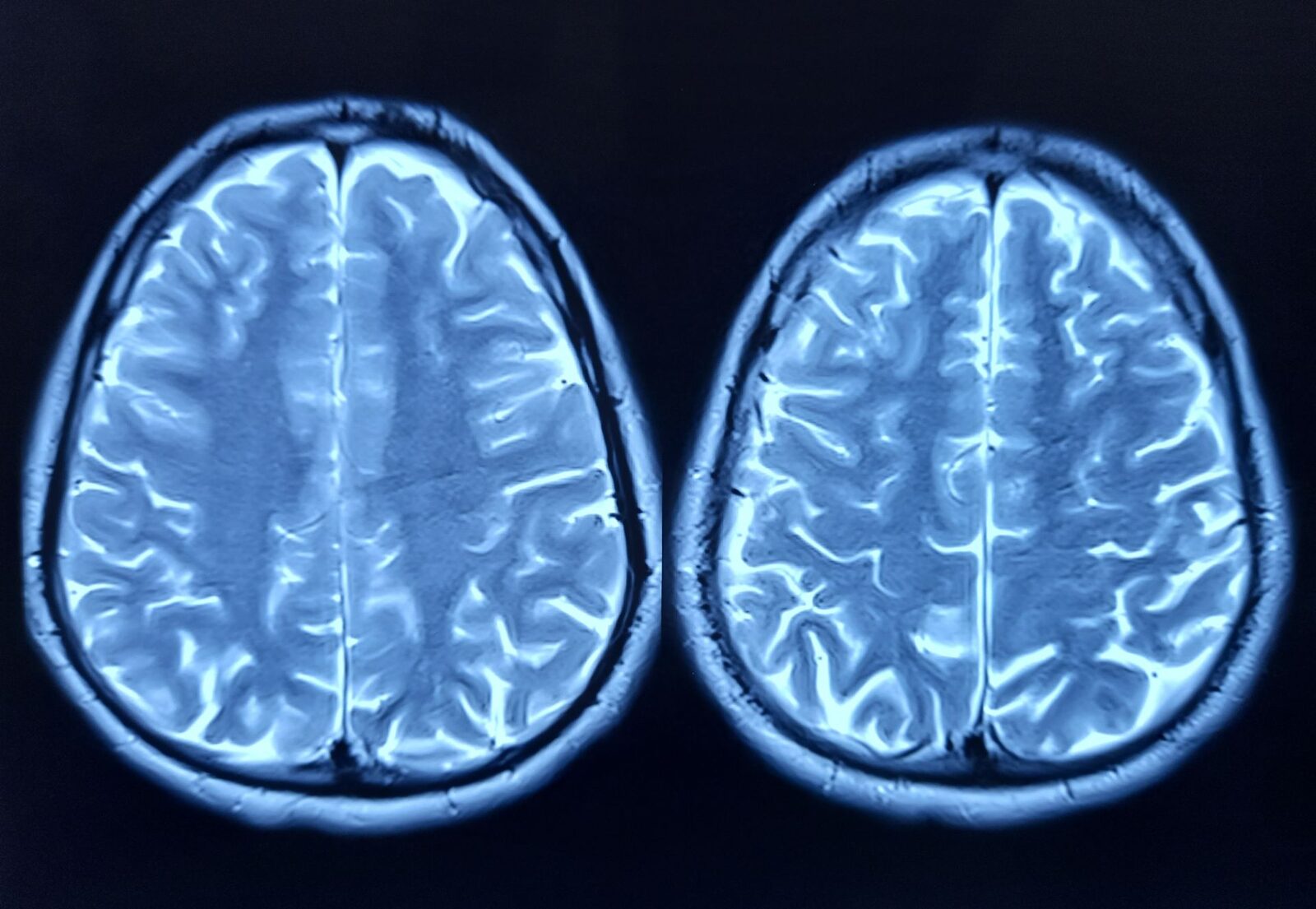 Depresia, o boală care-ți atacă neuronii