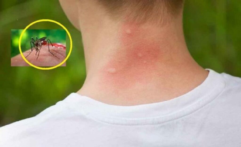 Țânțarii te aleg pe tine? Descoperite 3 bacterii ce-i atrag