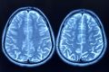 Craniu ascunde un nou organ al sistemului imunitar