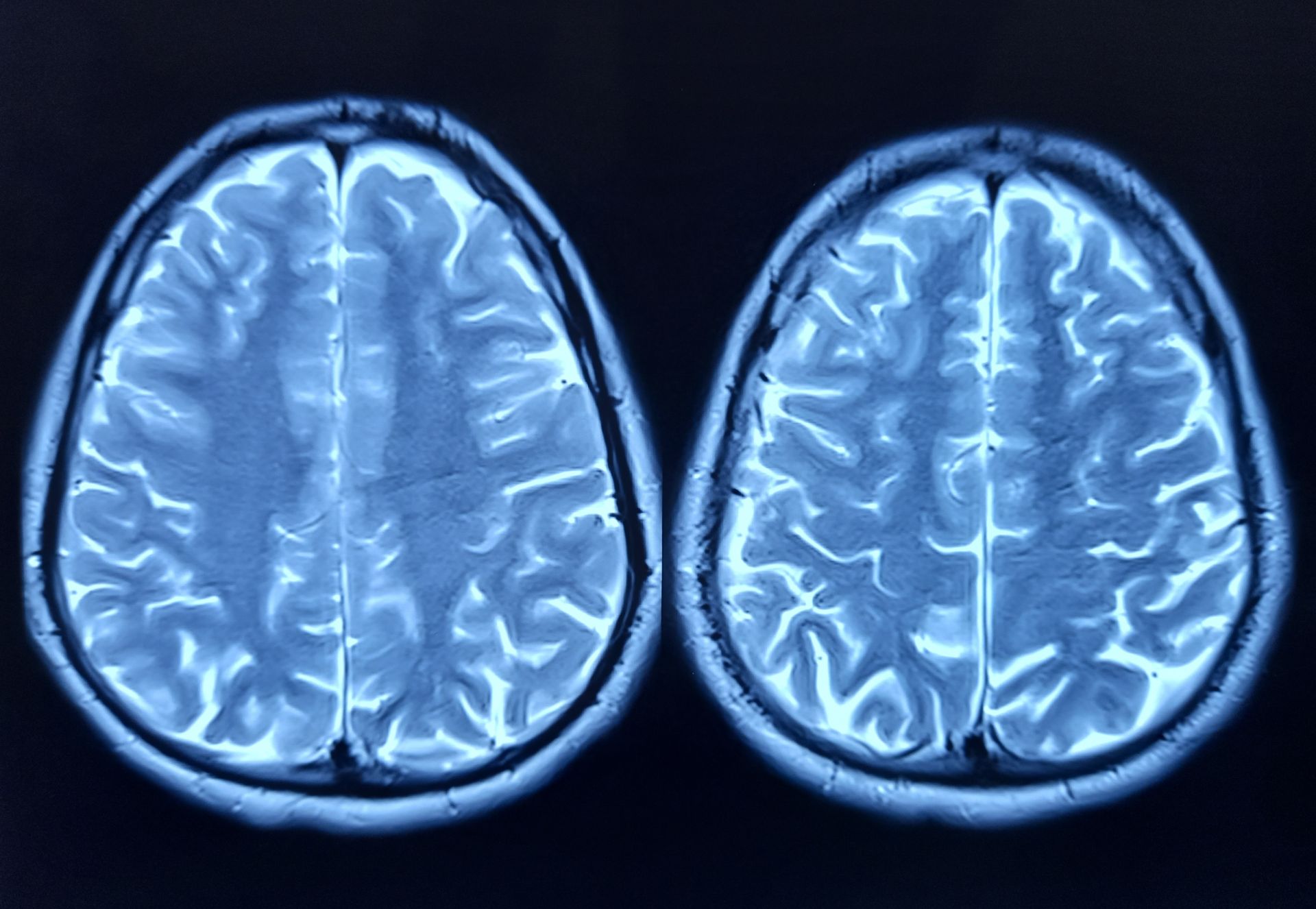 Craniu ascunde un nou organ al sistemului imunitar