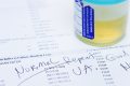 Test urină: 9 din 10 cancere vezică detectate
