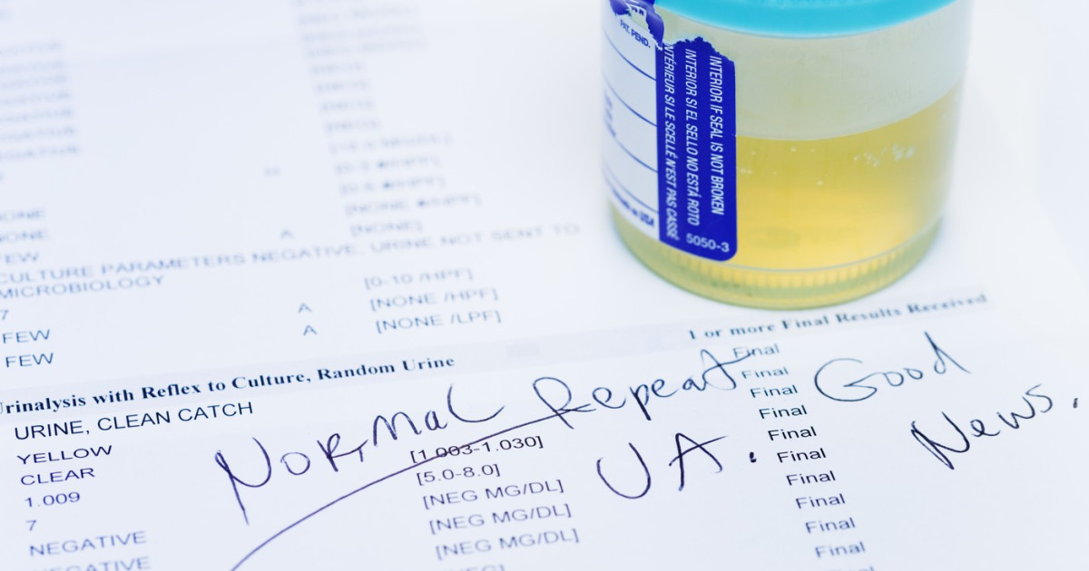 Test urină: 9 din 10 cancere vezică detectate