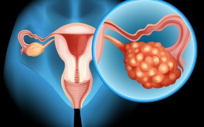 Fructoza accelerează cancerul ovarian și metastazele