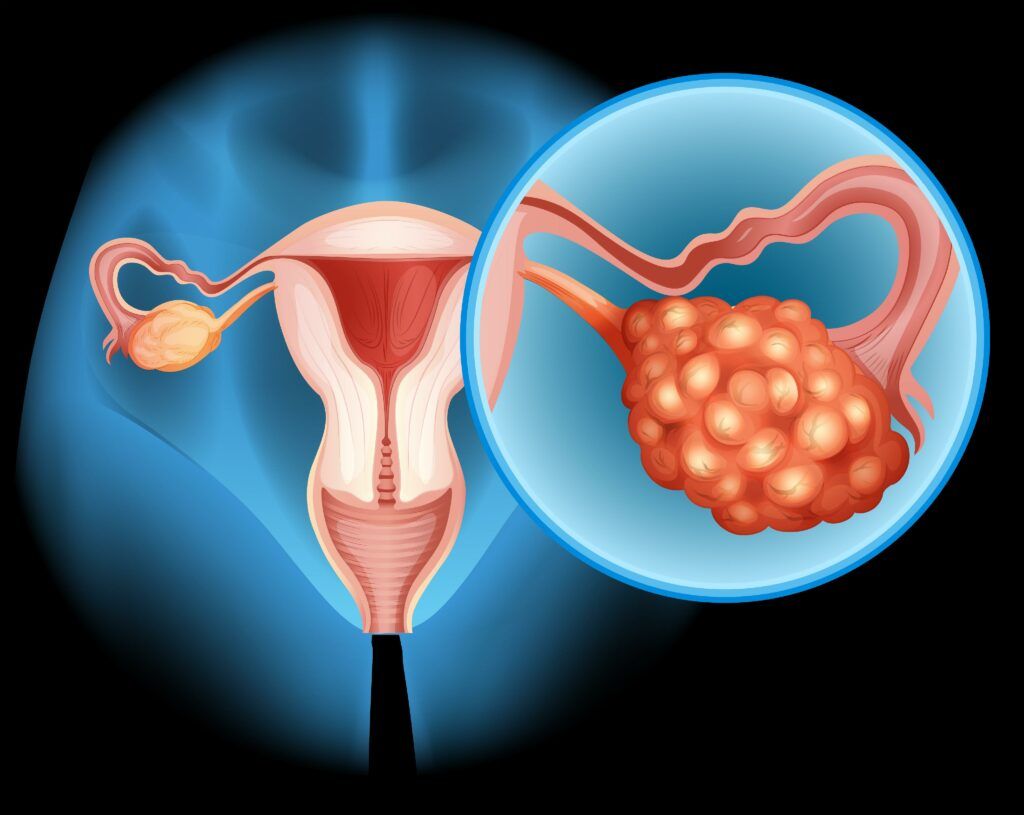 Fructoza accelerează cancerul ovarian și metastazele