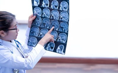 Leziuni cerebrale după AVC: O nouă cale ingenioasă de detecție