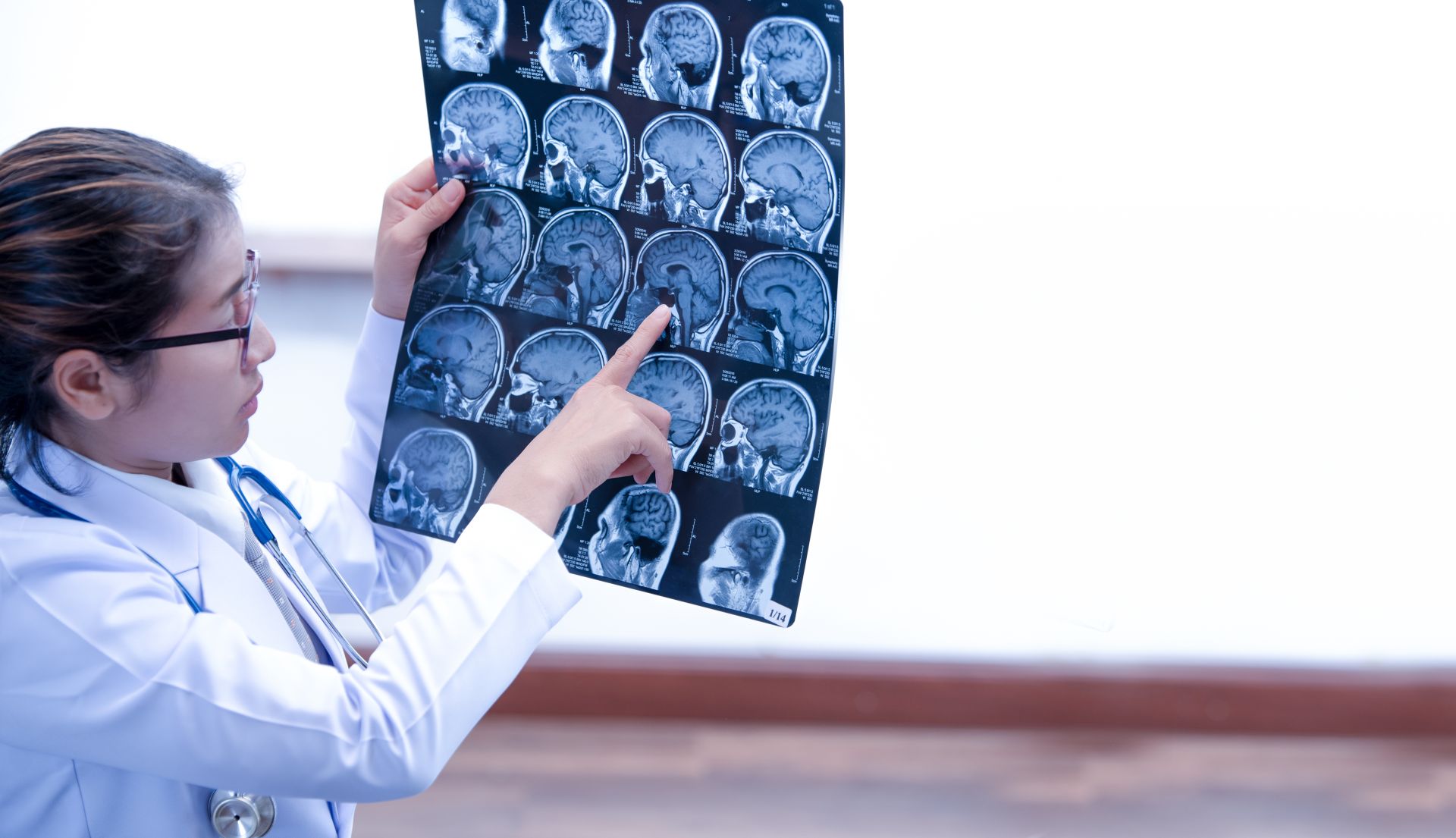 Leziuni cerebrale după AVC: O nouă cale ingenioasă de detecție